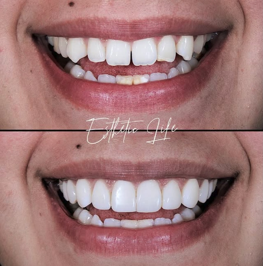 Antes y después — Carillas de Porcelana