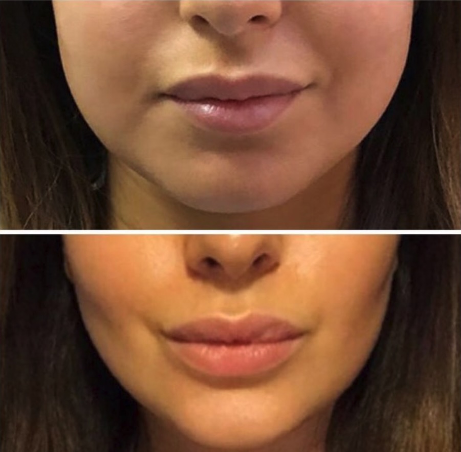 Antes y después — Perfilado Labial