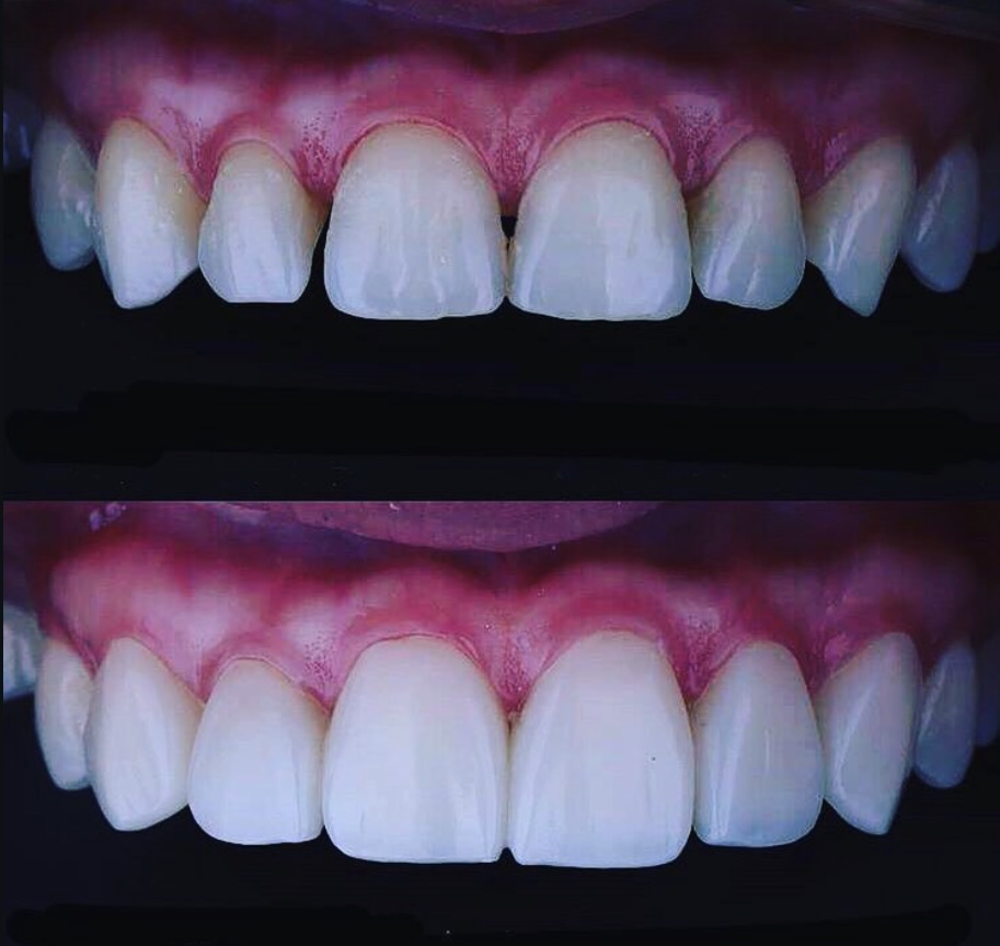 Antes y después — Rehabilitación Oral